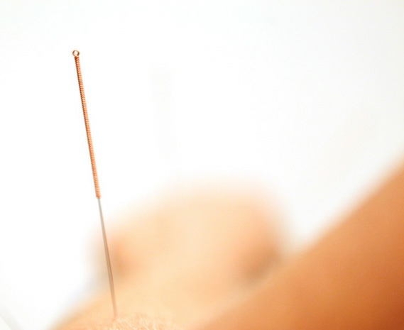 Consulter Acupuncteur Angers